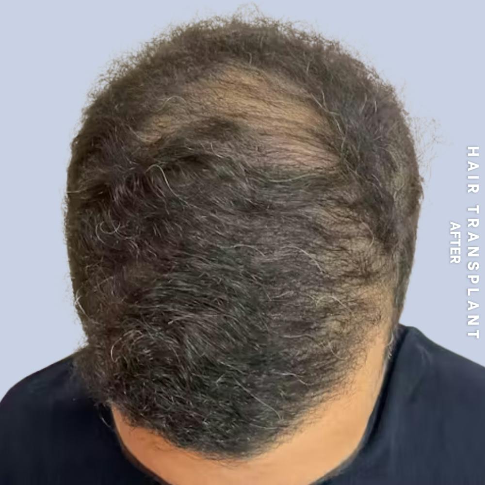 Hair Restoration Before & After Gallery - Patient 223060 - Image 2