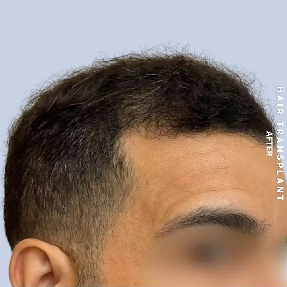 Hair Restoration Before & After Gallery - Patient 223060 - Image 4