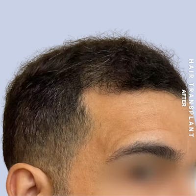 Hair Restoration Before & After Gallery - Patient 223060 - Image 4