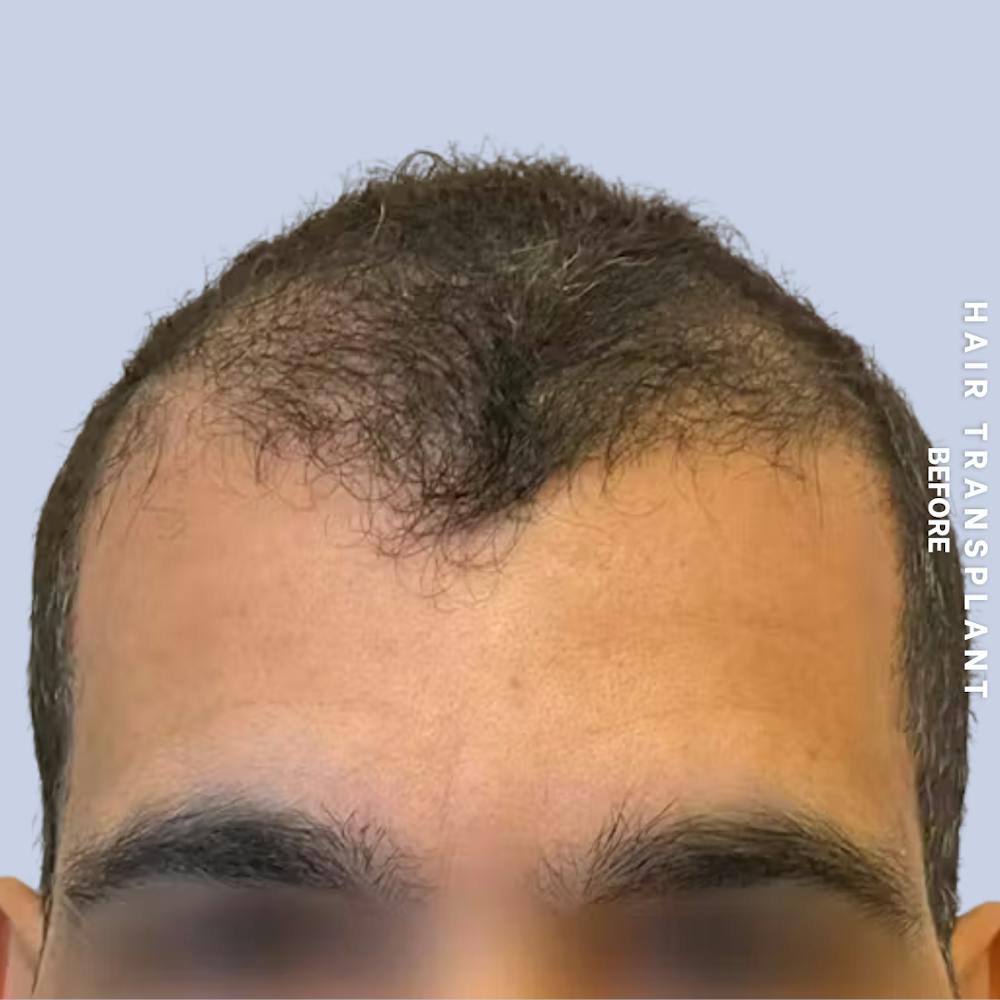 Hair Restoration Before & After Gallery - Patient 223060 - Image 5