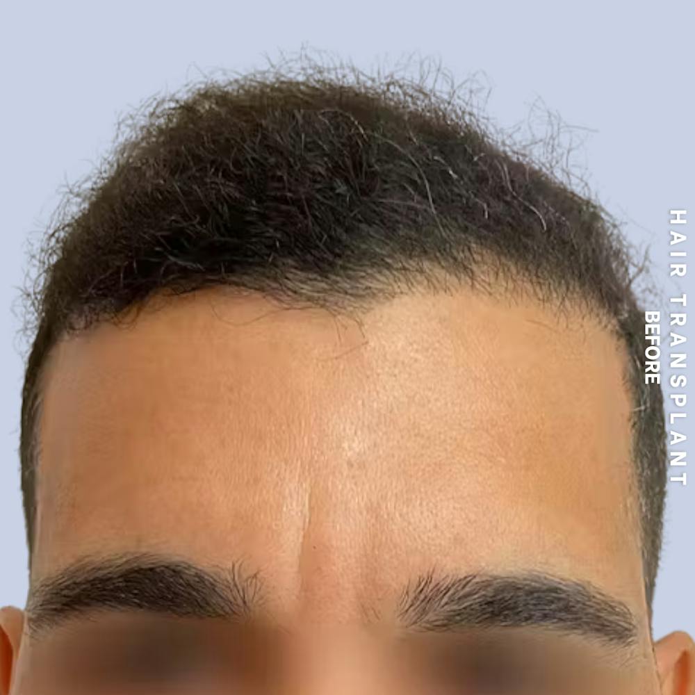 Hair Restoration Before & After Gallery - Patient 223060 - Image 6
