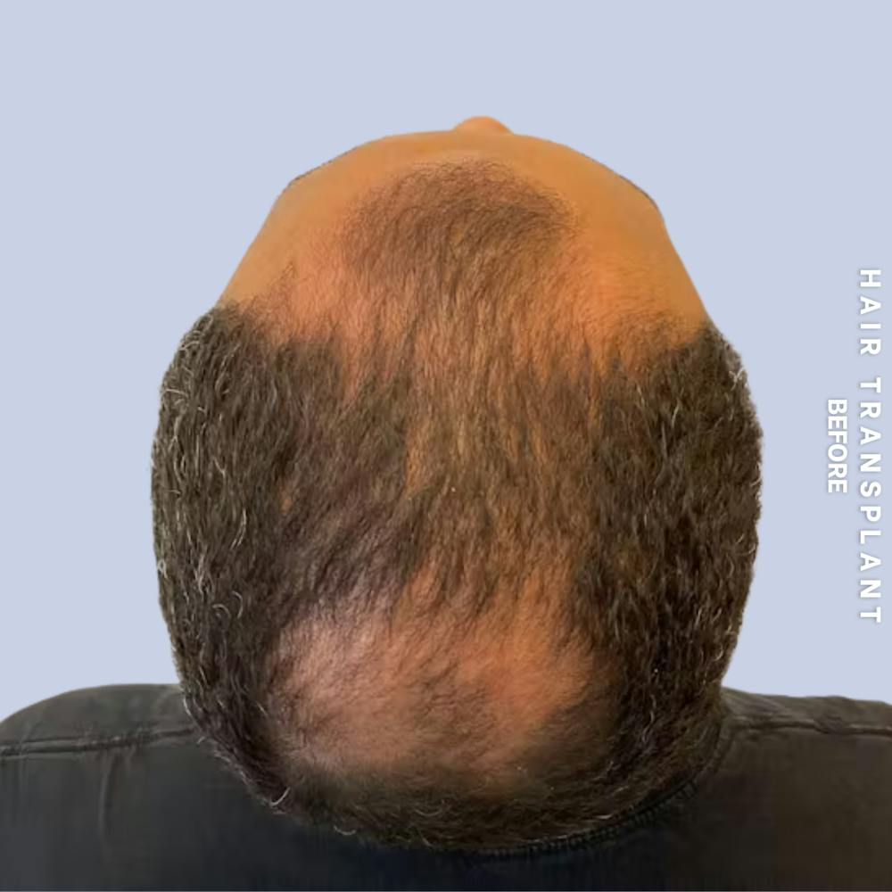 Hair Restoration Before & After Gallery - Patient 218492 - Image 1