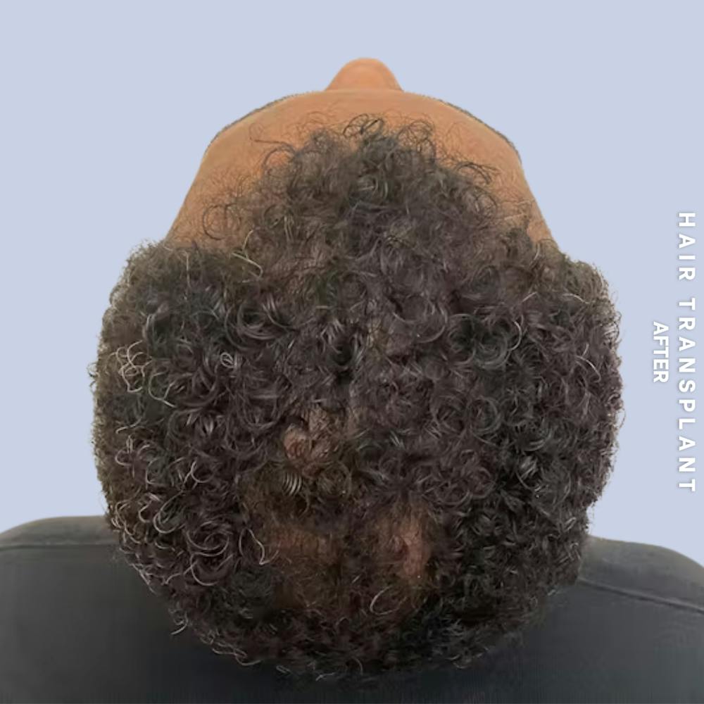 Hair Restoration Before & After Gallery - Patient 218492 - Image 2
