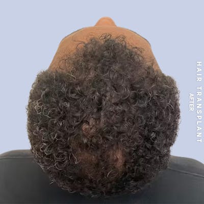 Hair Restoration Before & After Gallery - Patient 218492 - Image 2