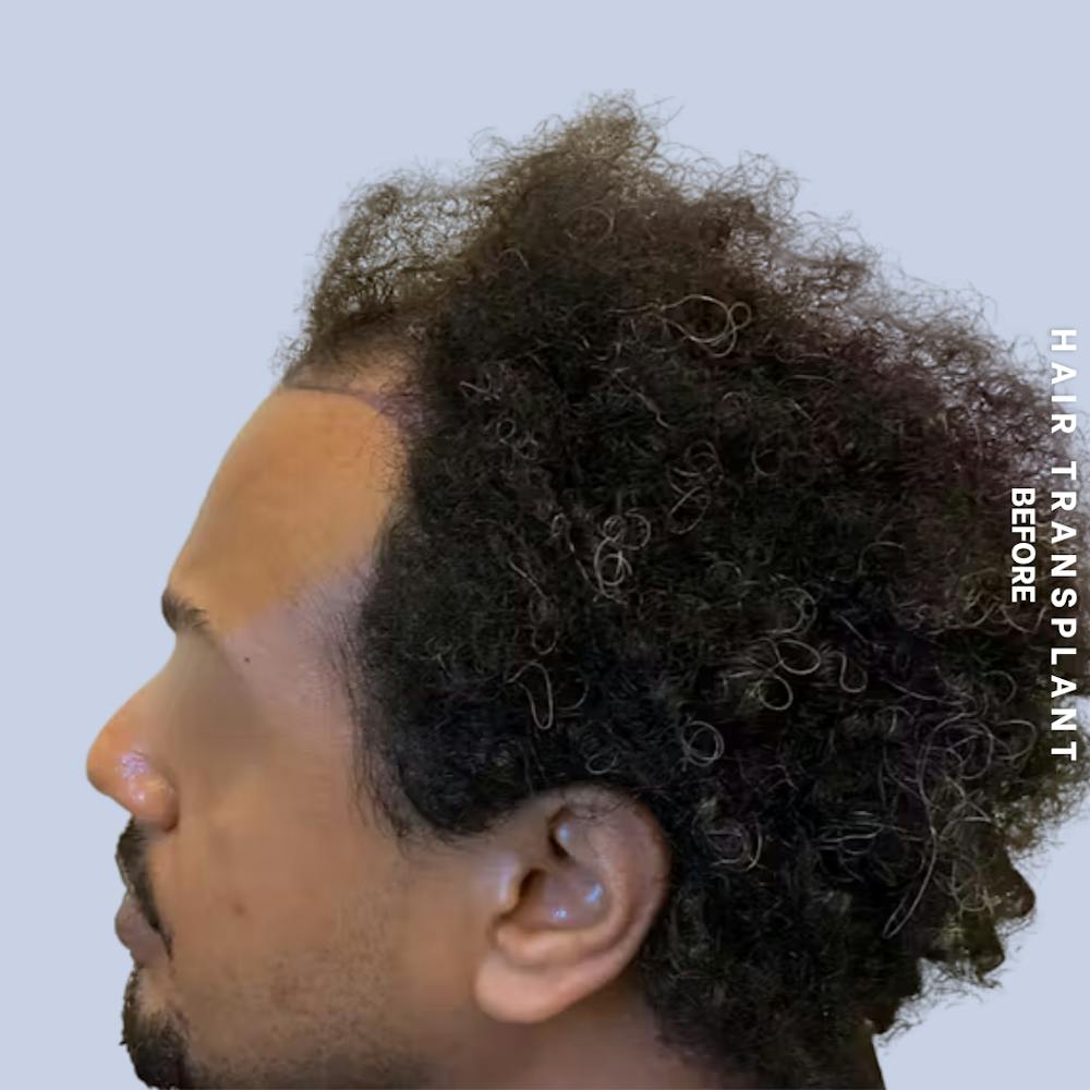 Hair Restoration Before & After Gallery - Patient 218492 - Image 3