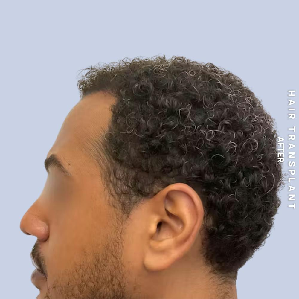 Hair Restoration Before & After Gallery - Patient 218492 - Image 4