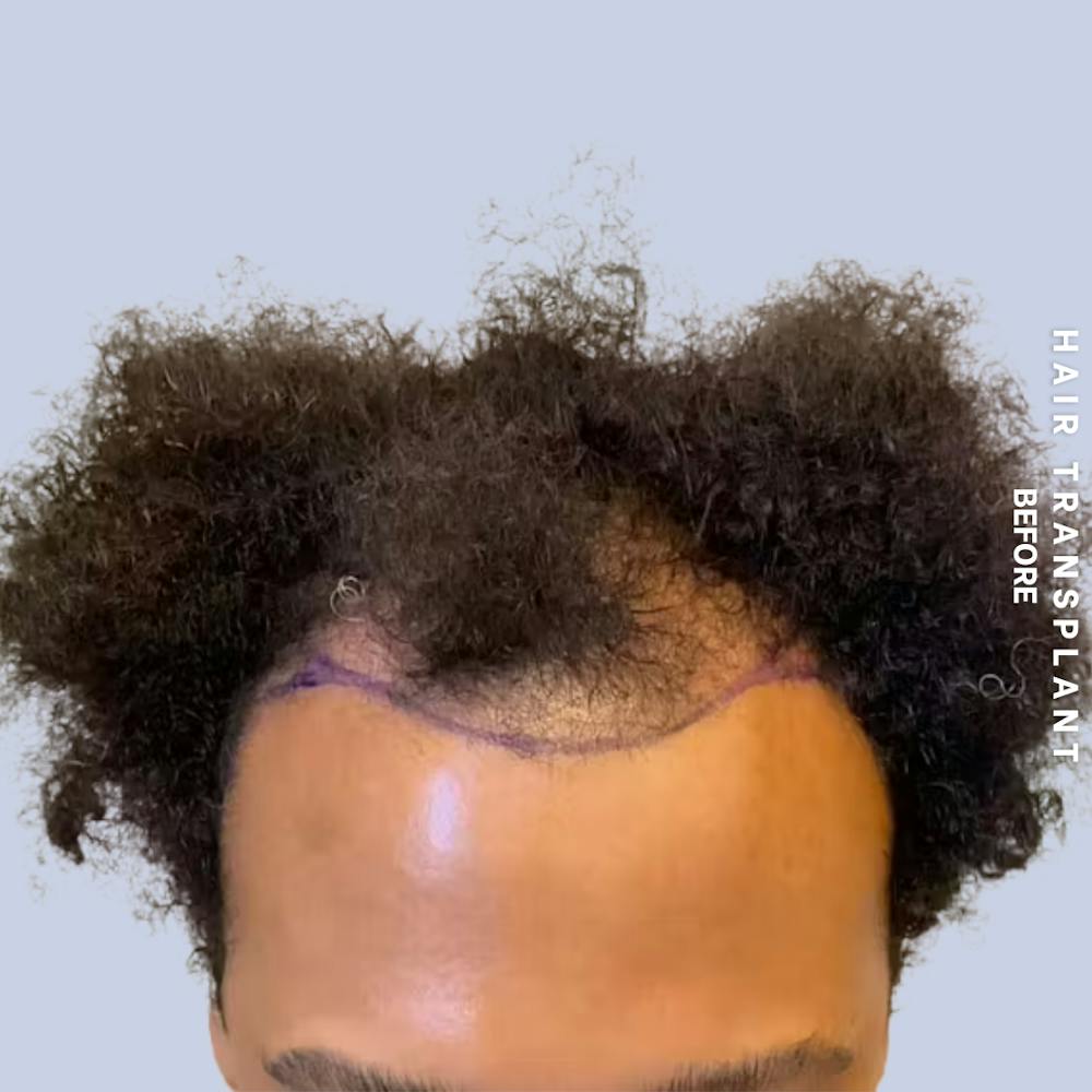 Hair Restoration Before & After Gallery - Patient 218492 - Image 5