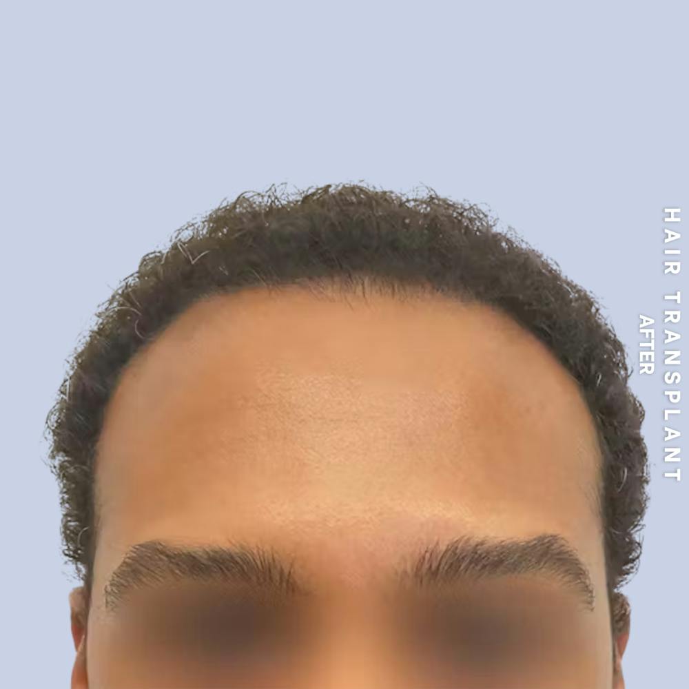 Hair Restoration Before & After Gallery - Patient 218492 - Image 6
