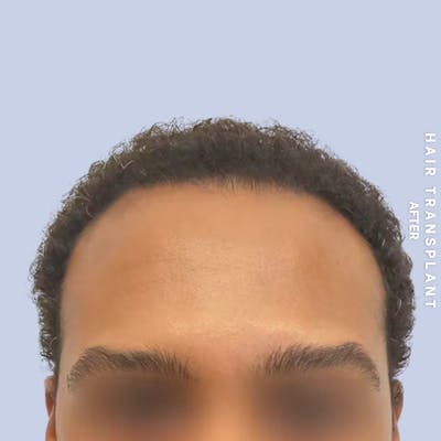 Hair Restoration Before & After Gallery - Patient 218492 - Image 6