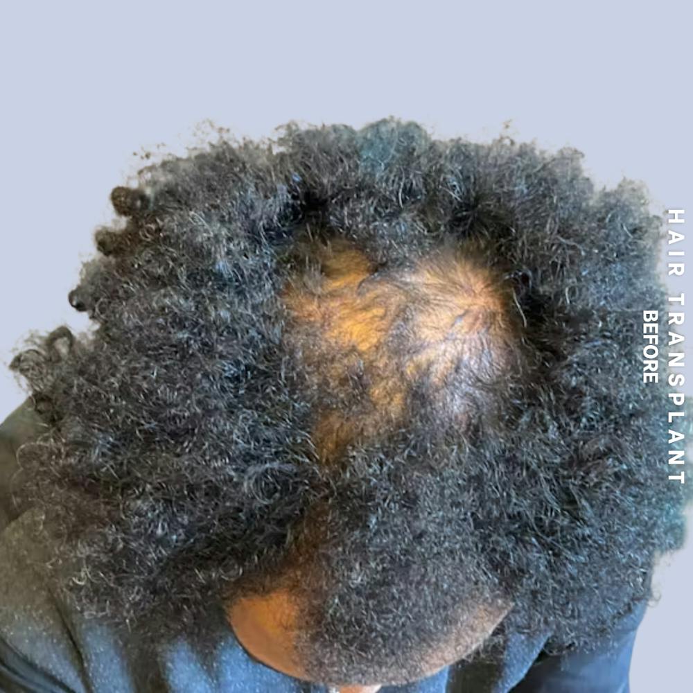 Hair Restoration Before & After Gallery - Patient 218492 - Image 7