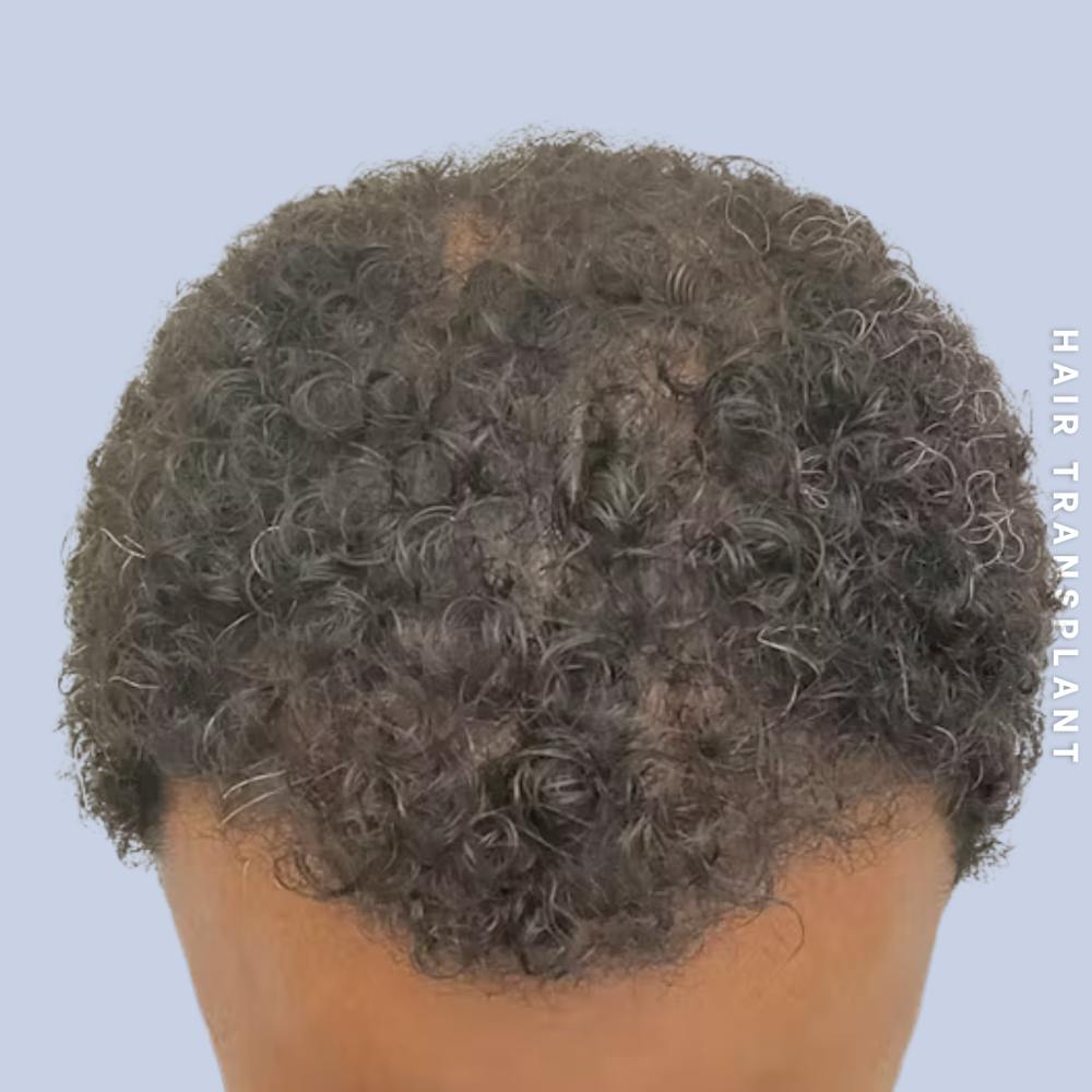 Hair Restoration Before & After Gallery - Patient 218492 - Image 8