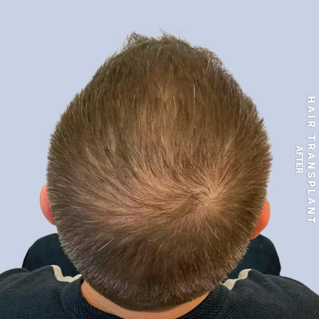 Men's Hair Before & After Gallery - Patient 273078 - Image 2