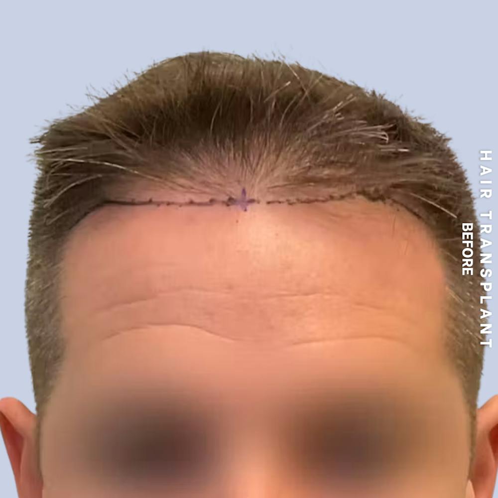 Hair Restoration Before & After Gallery - Patient 308590 - Image 3