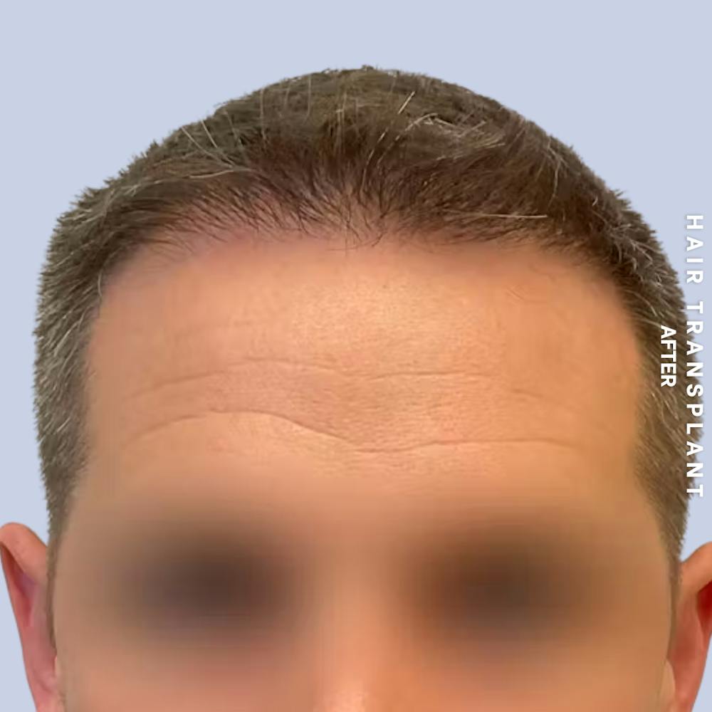 Hair Restoration Before & After Gallery - Patient 308590 - Image 4
