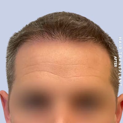 Hair Restoration Before & After Gallery - Patient 308590 - Image 4