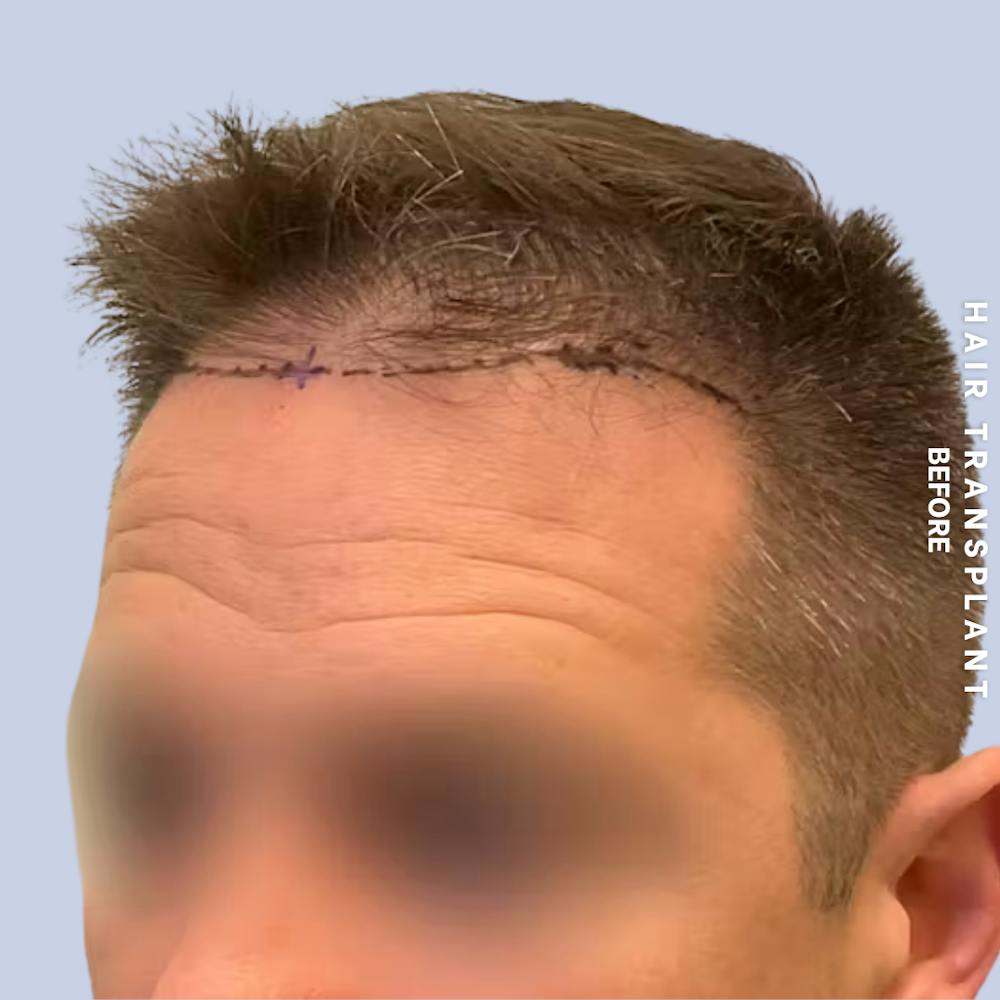 Hair Restoration Before & After Gallery - Patient 308590 - Image 5