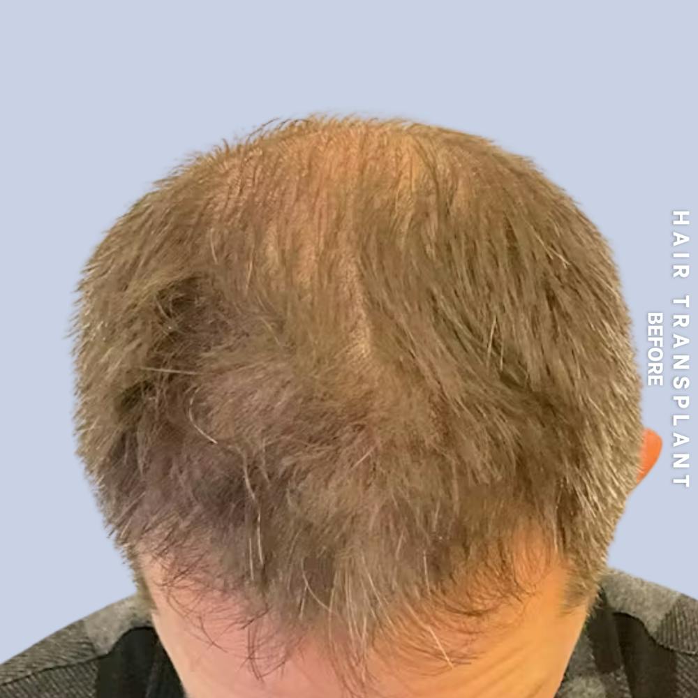Hair Restoration Before & After Gallery - Patient 308590 - Image 7