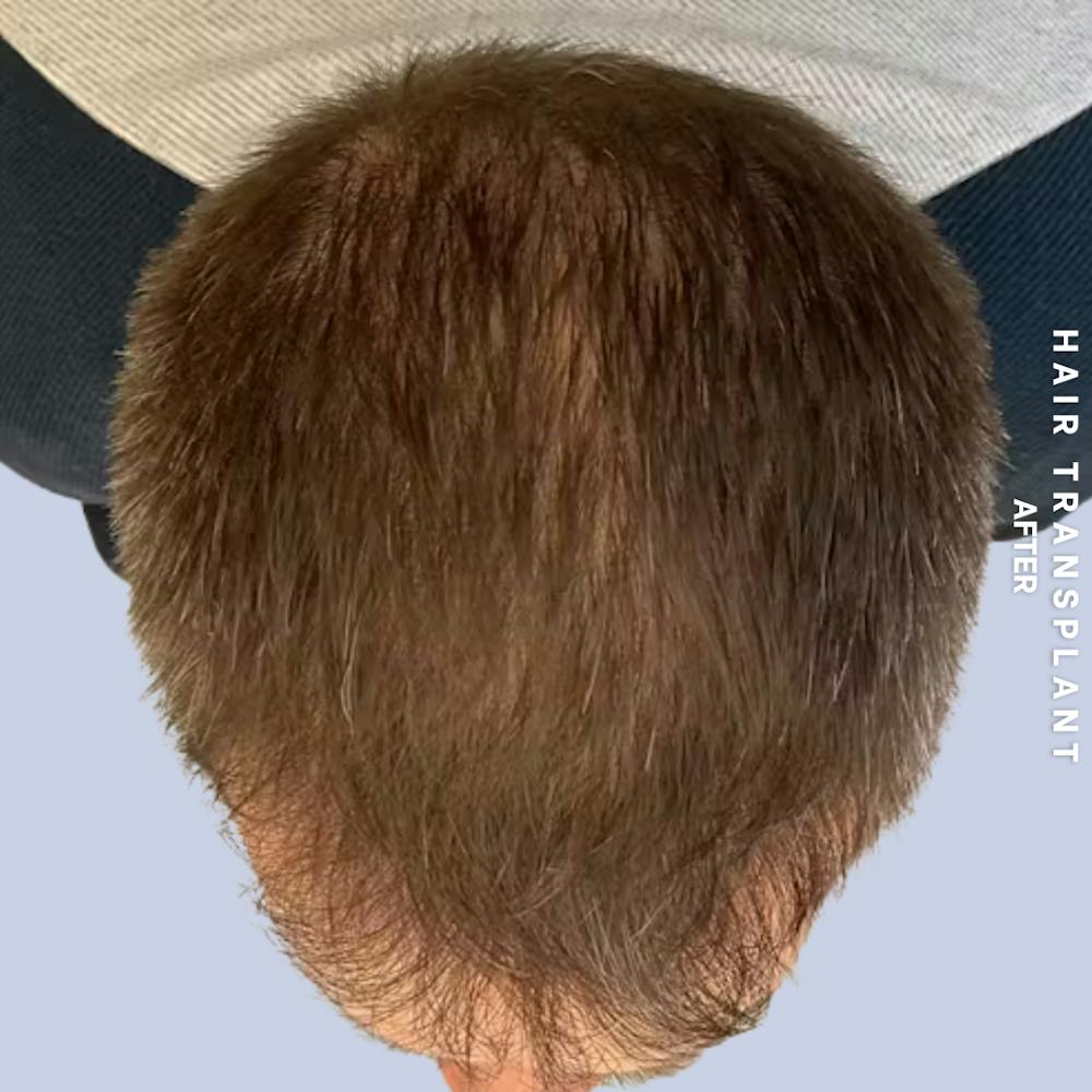Hair Restoration Before & After Gallery - Patient 308590 - Image 8