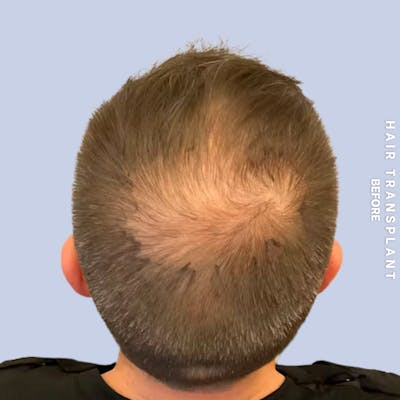 Hair Restoration Before & After Gallery - Patient 308590 - Image 1