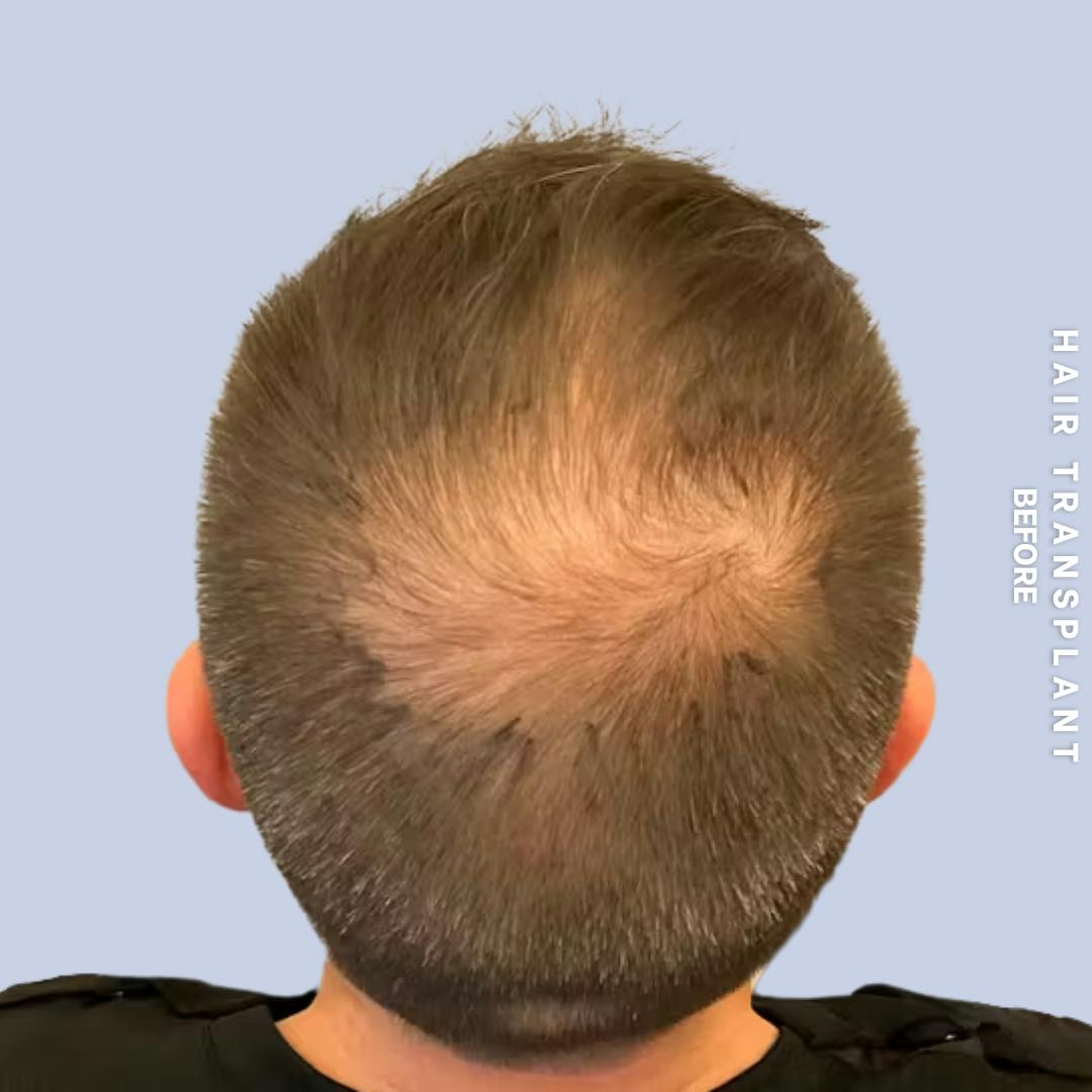 Men's Hair Before & After Gallery - Patient 273078 - Image 1