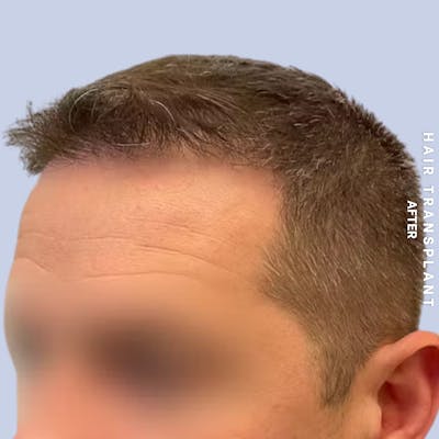Hair Restoration Before & After Gallery - Patient 308590 - Image 6