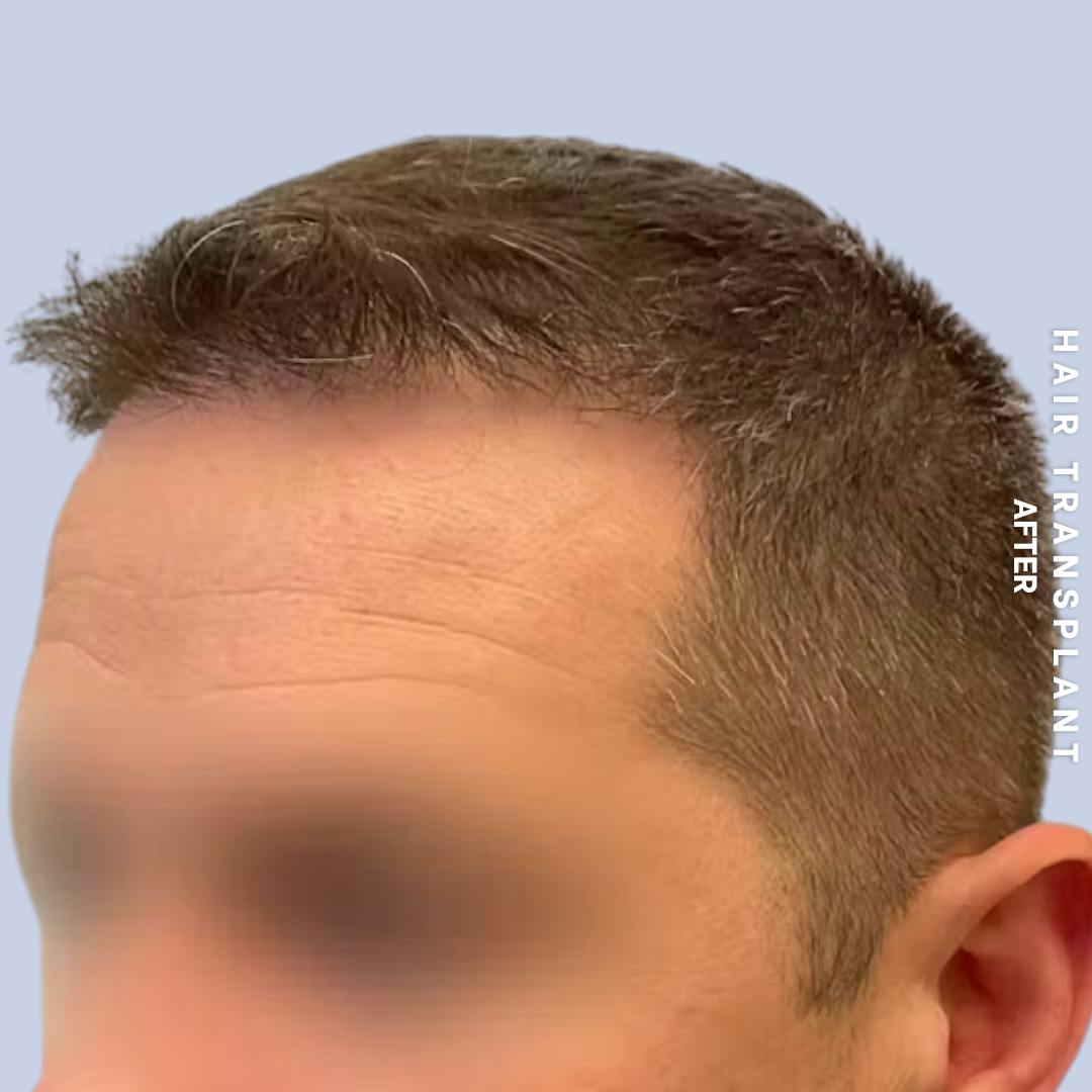 Men's Hair Before & After Gallery - Patient 273078 - Image 6