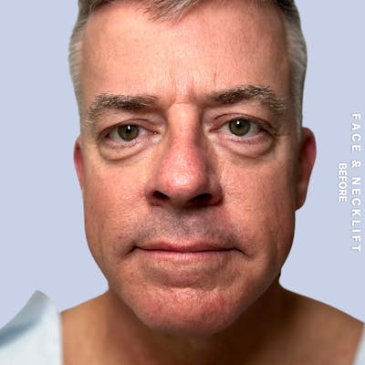 Face & Neck Before & After Gallery - Patient 272607 - Image 1