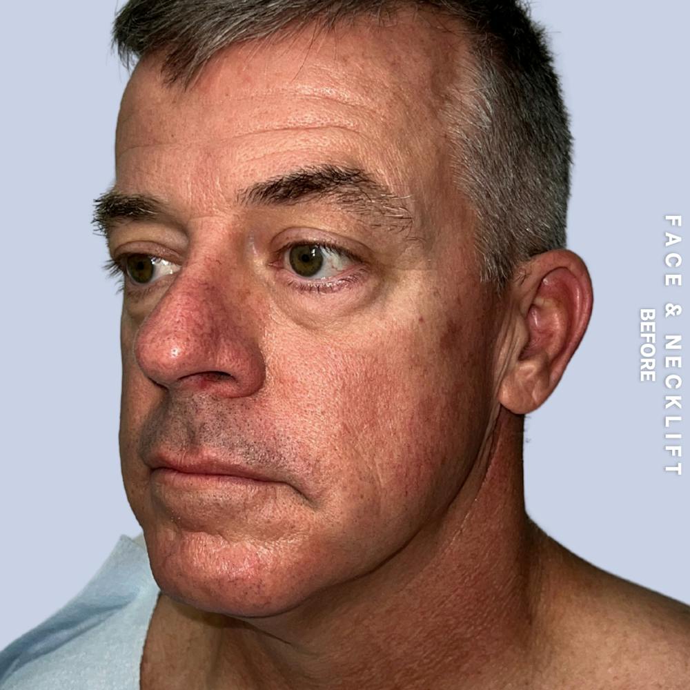 Face & Neck Before & After Gallery - Patient 272607 - Image 3