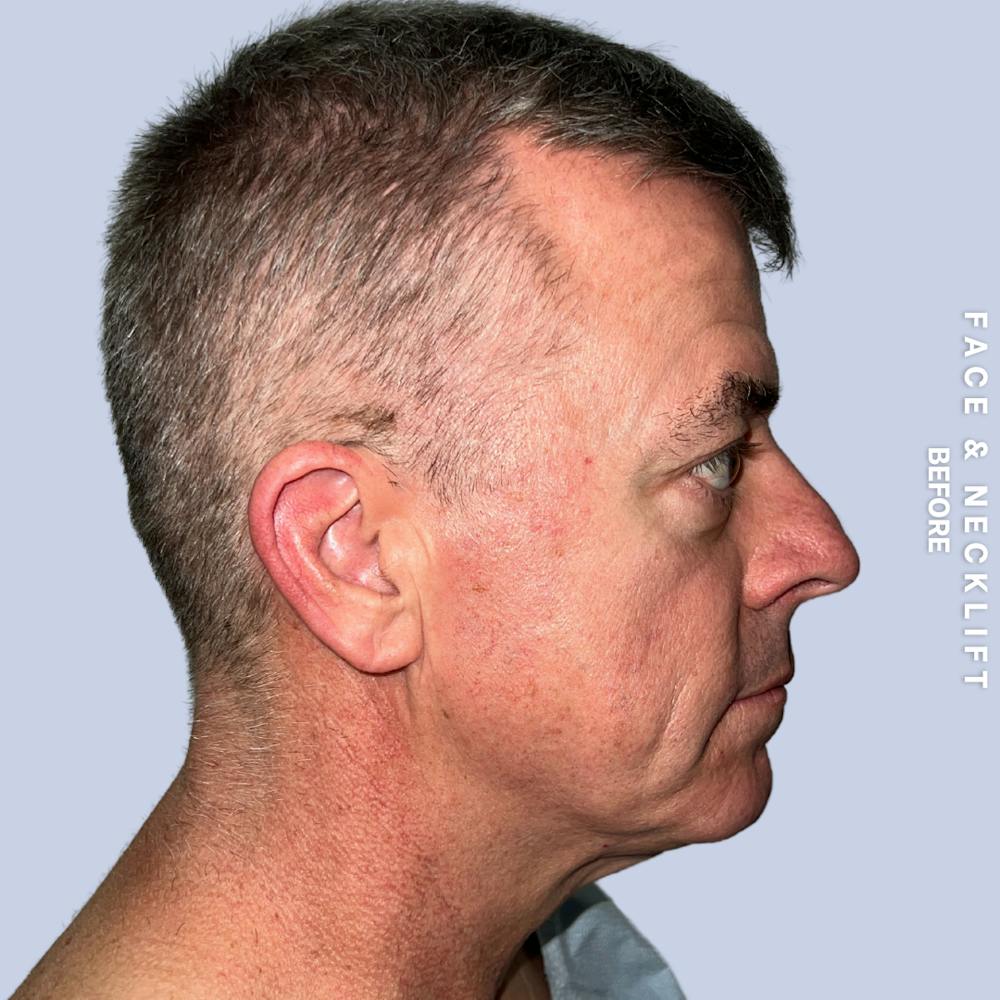 Face & Neck Before & After Gallery - Patient 272607 - Image 5