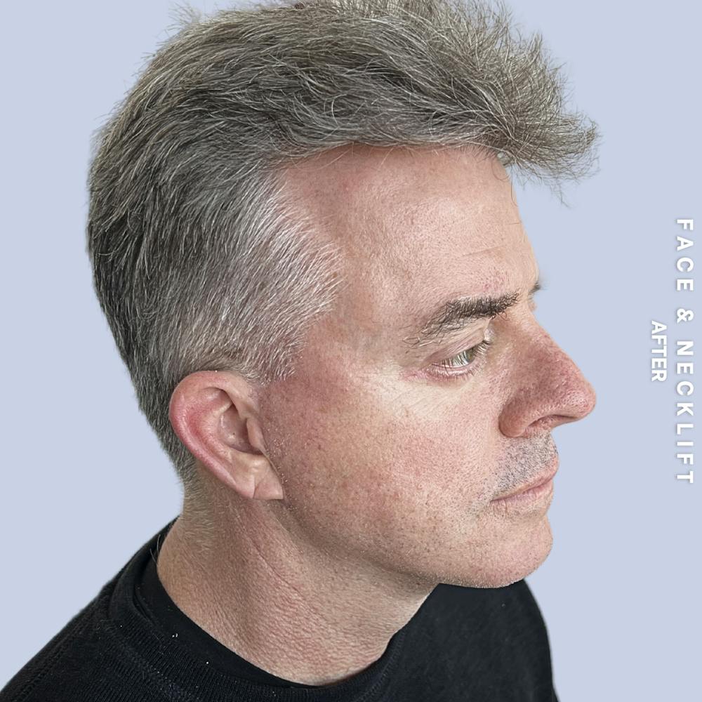 Face & Neck Before & After Gallery - Patient 272607 - Image 6