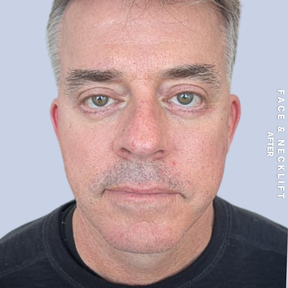 Face & Neck Before & After Gallery - Patient 272607 - Image 2
