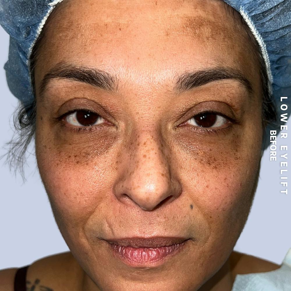 Eyes Before & After Gallery - Patient 100543 - Image 1