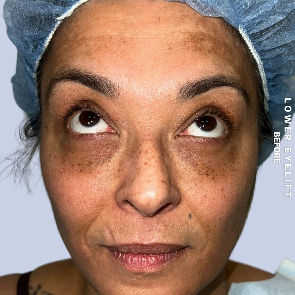 Eyes Before & After Gallery - Patient 100543 - Image 3