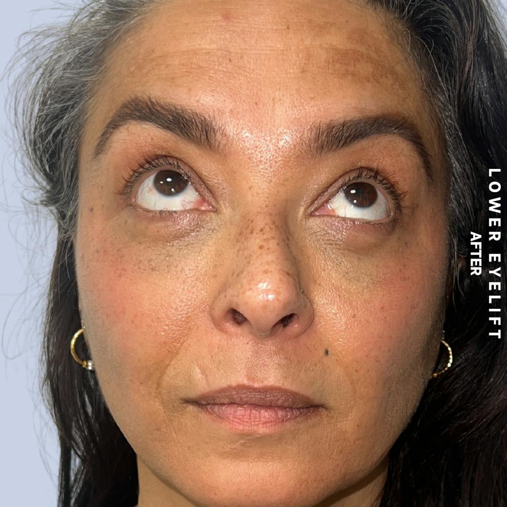 Eyes Before & After Gallery - Patient 100543 - Image 4
