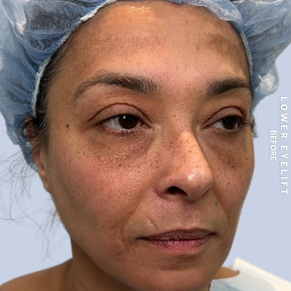 Eyes Before & After Gallery - Patient 100543 - Image 5