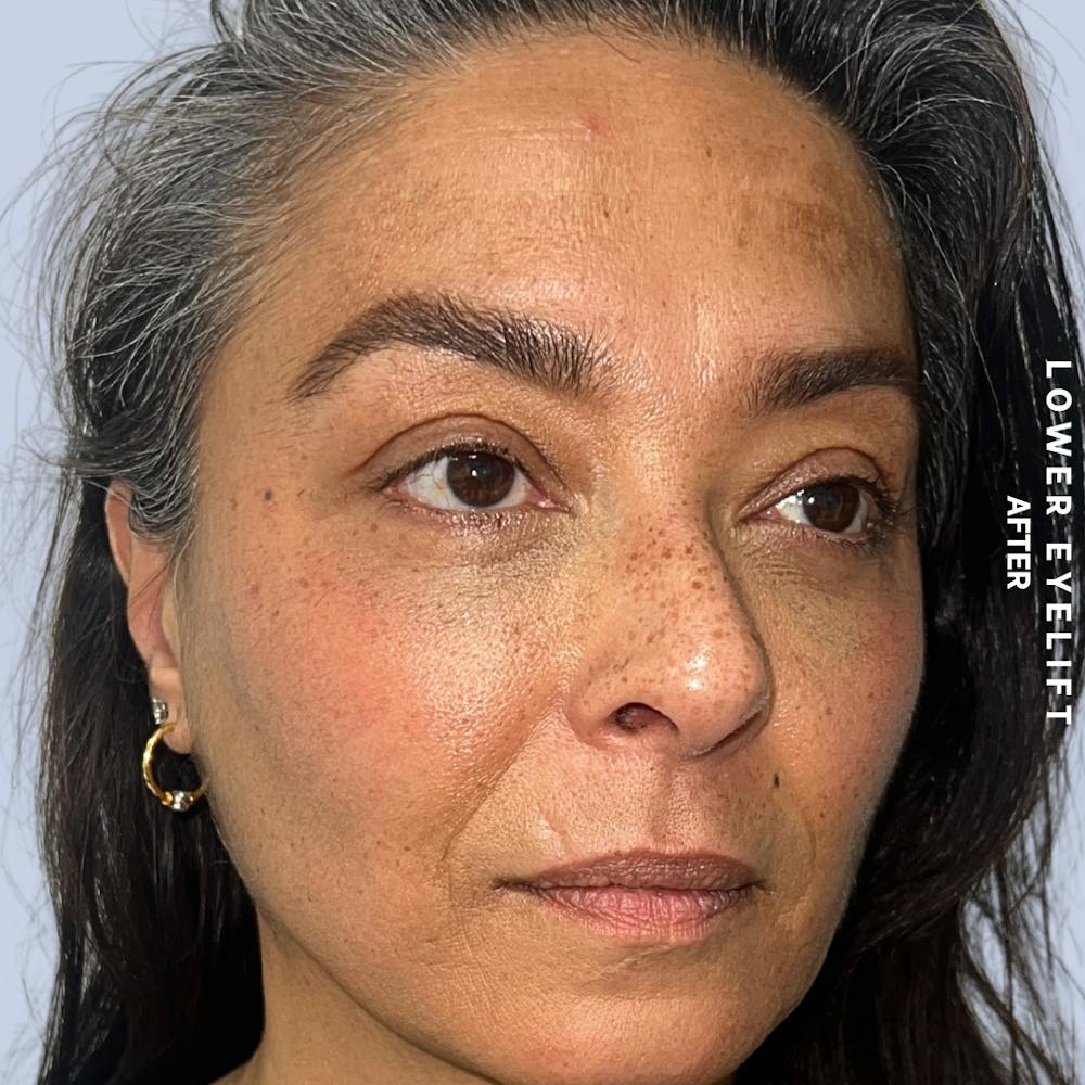 Eyes Before & After Gallery - Patient 100543 - Image 6