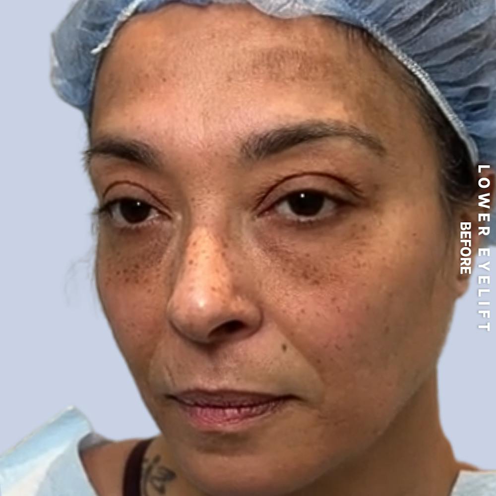 Eyes Before & After Gallery - Patient 100543 - Image 7