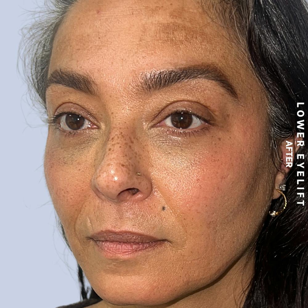Eyes Before & After Gallery - Patient 100543 - Image 8