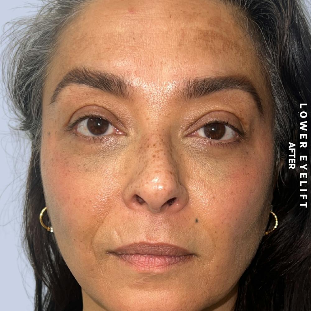 Eyes Before & After Gallery - Patient 100543 - Image 2