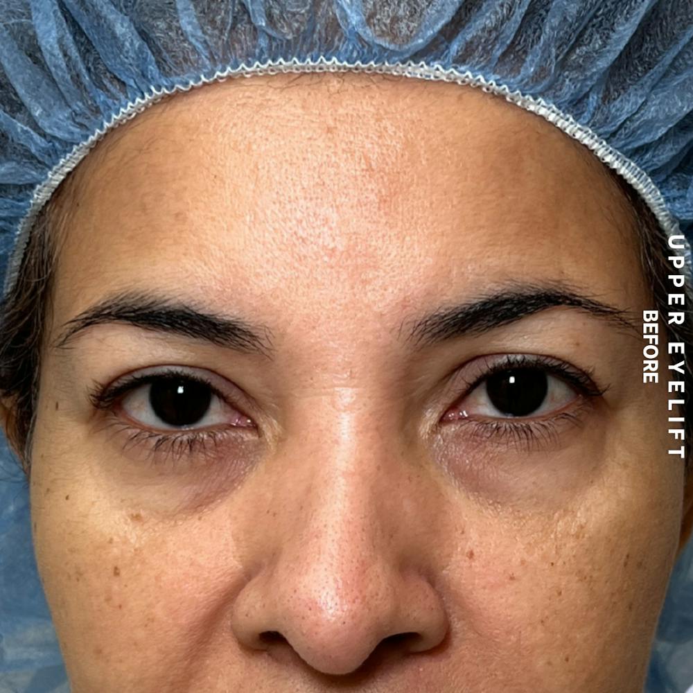 Eyes Before & After Gallery - Patient 354091 - Image 1