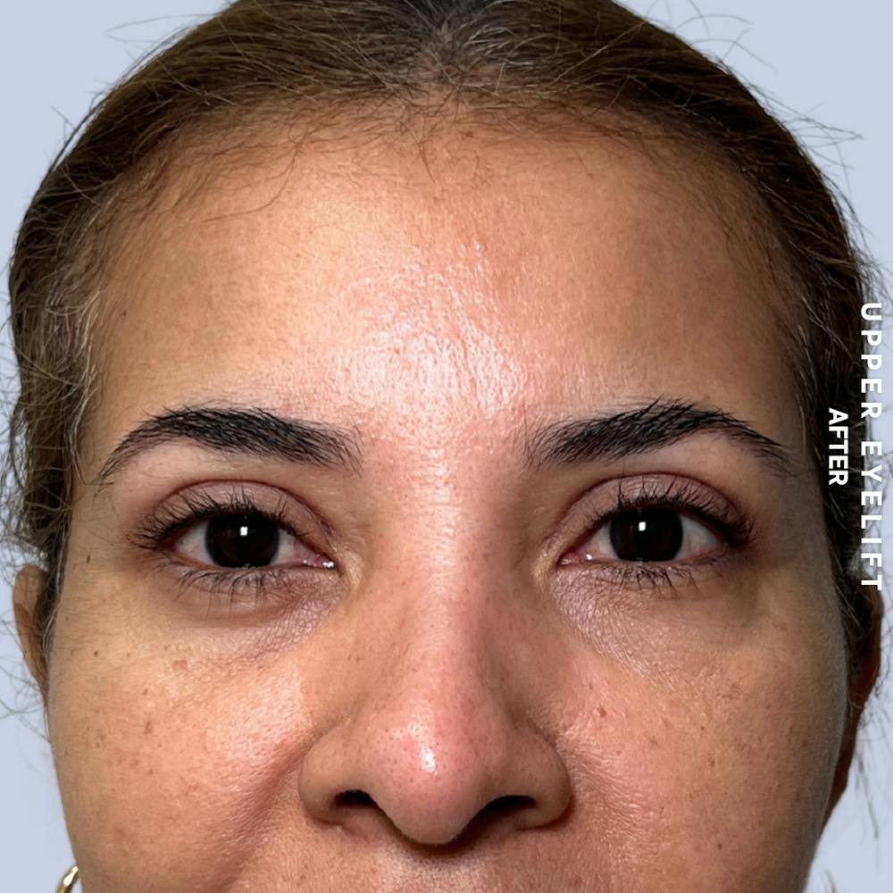Eyes Before & After Gallery - Patient 354091 - Image 2