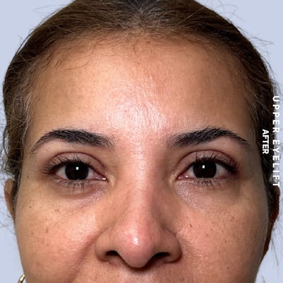 Eyes Before & After Gallery - Patient 354091 - Image 2