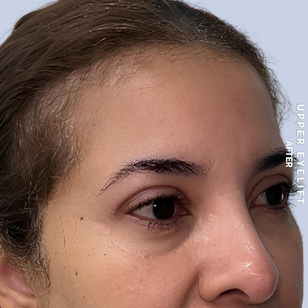 Eyes Before & After Gallery - Patient 354091 - Image 4