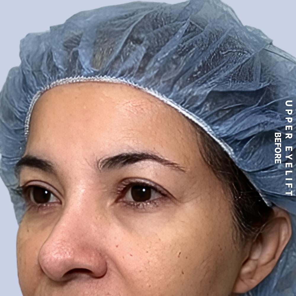 Eyes Before & After Gallery - Patient 354091 - Image 5