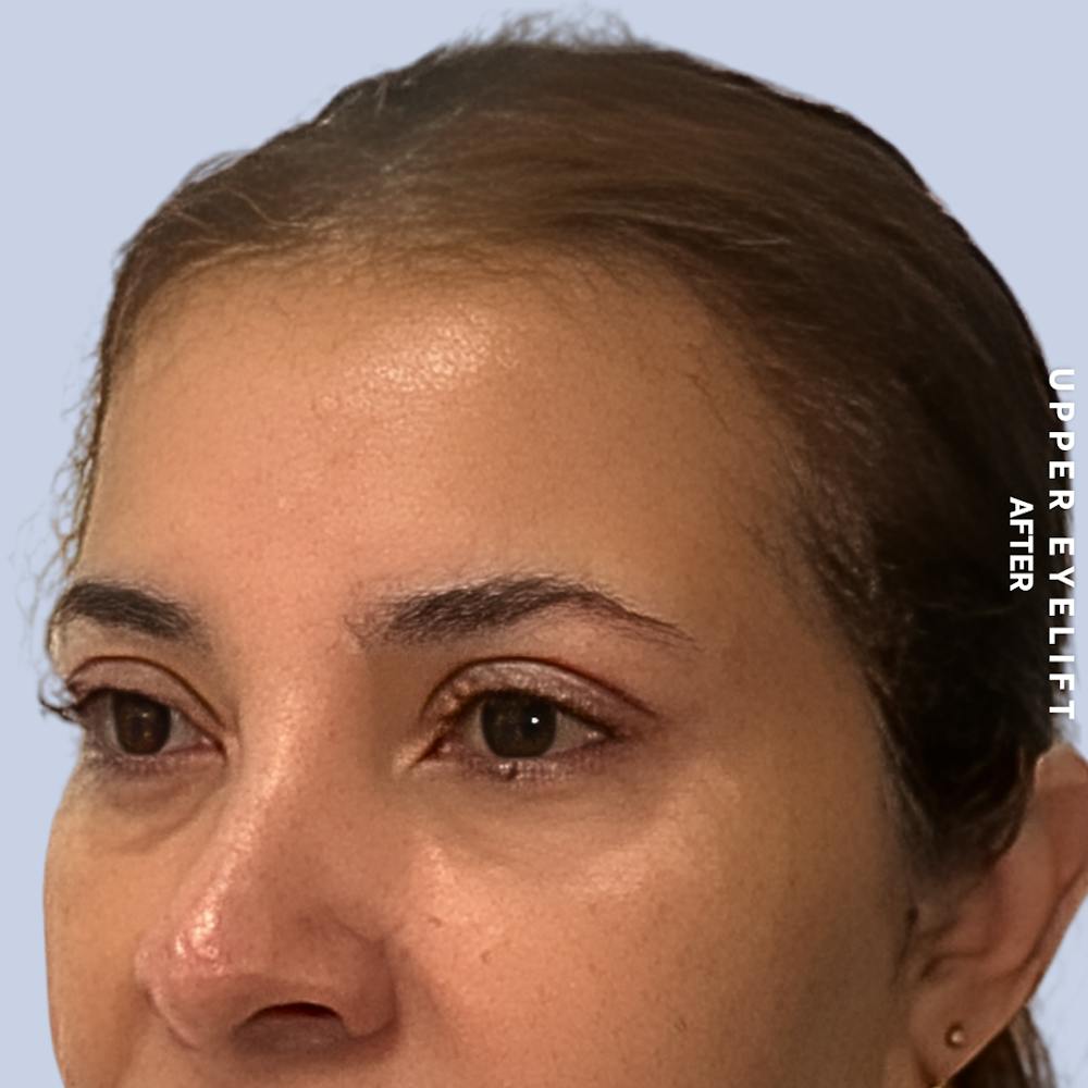 Eyes Before & After Gallery - Patient 354091 - Image 6