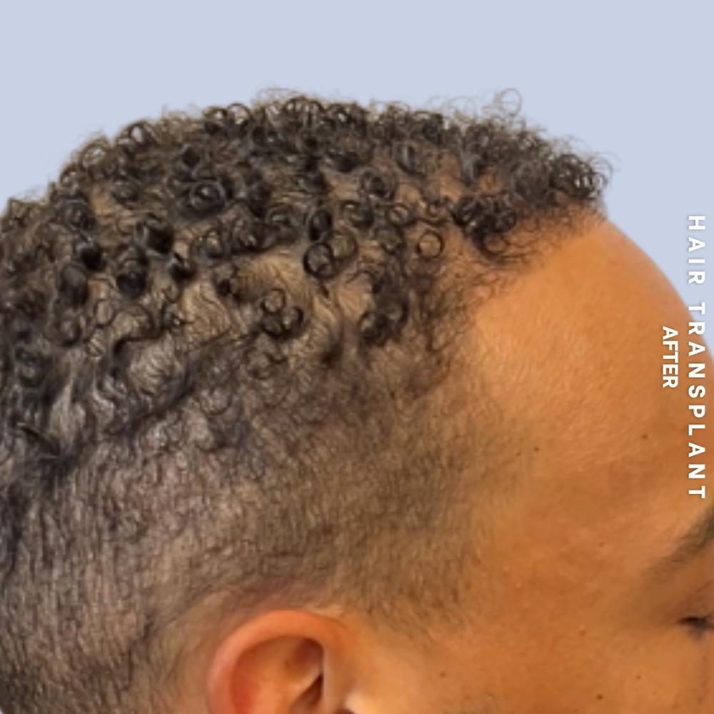 Hair Restoration Before & After Gallery - Patient 231131 - Image 4