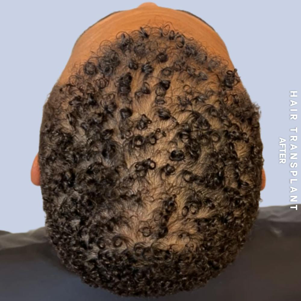 Hair Restoration Before & After Gallery - Patient 231131 - Image 6