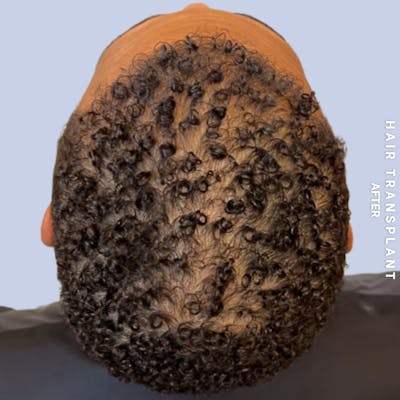 Hair Restoration Before & After Gallery - Patient 231131 - Image 6