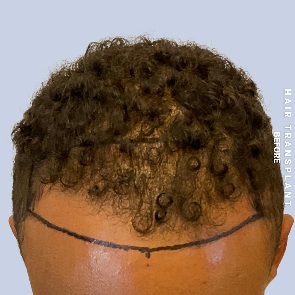 Hair Restoration Before & After Gallery - Patient 231131 - Image 1