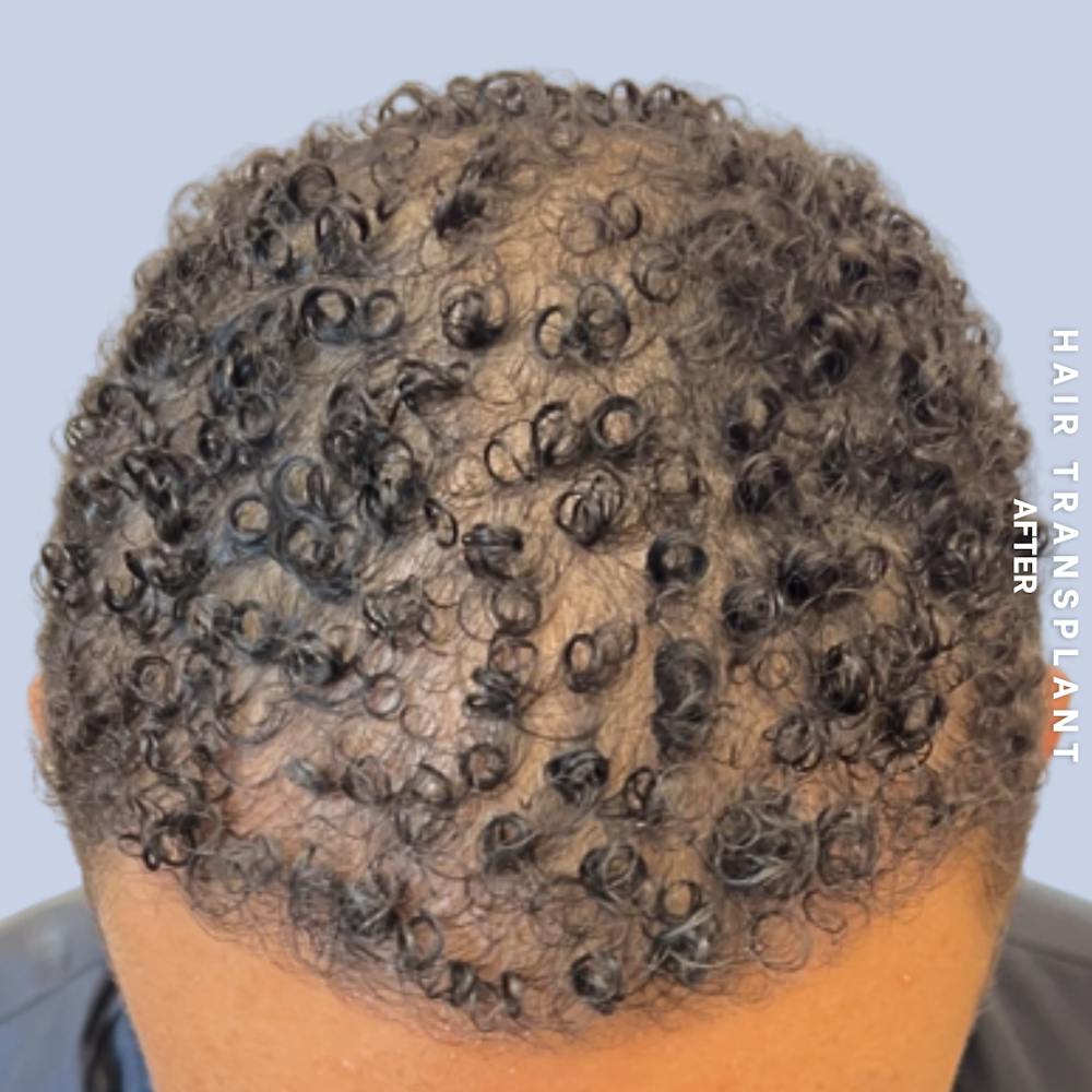 Hair Restoration Before & After Gallery - Patient 231131 - Image 2